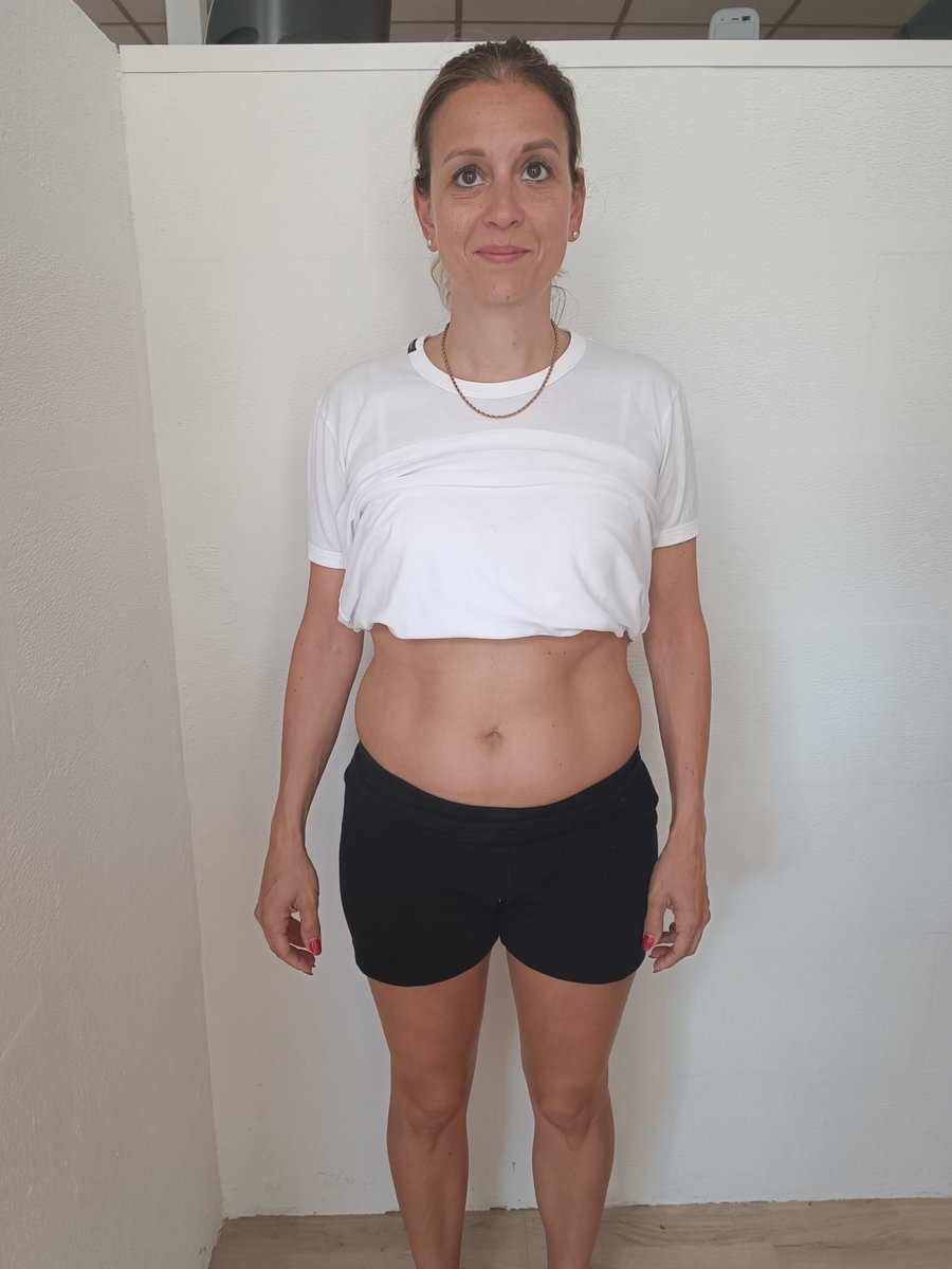 Serbanescu vor der EM-Bodyshaper Behandlung