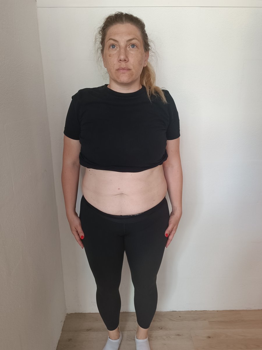 Ana vor der EM-Bodyshaper Behandlung